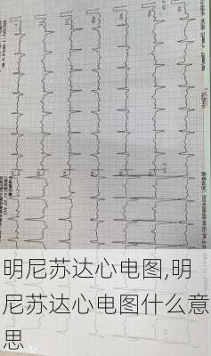 明尼苏达心电图,明尼苏达心电图什么意思