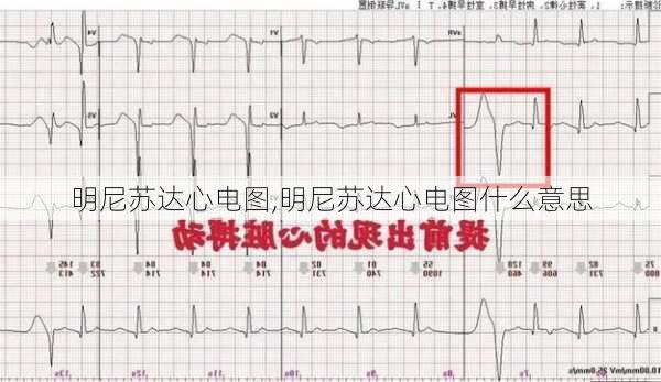 明尼苏达心电图,明尼苏达心电图什么意思