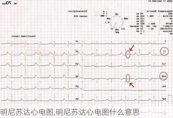 明尼苏达心电图,明尼苏达心电图什么意思